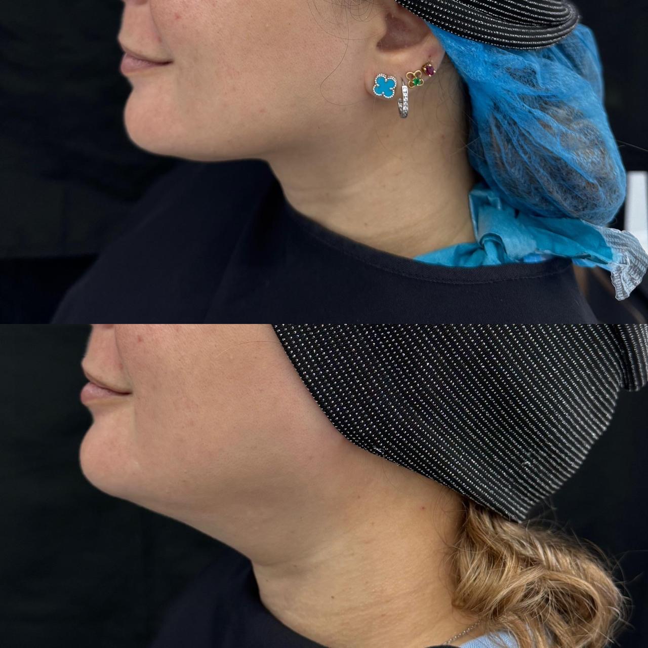 Jawline comparison showing visible contour change