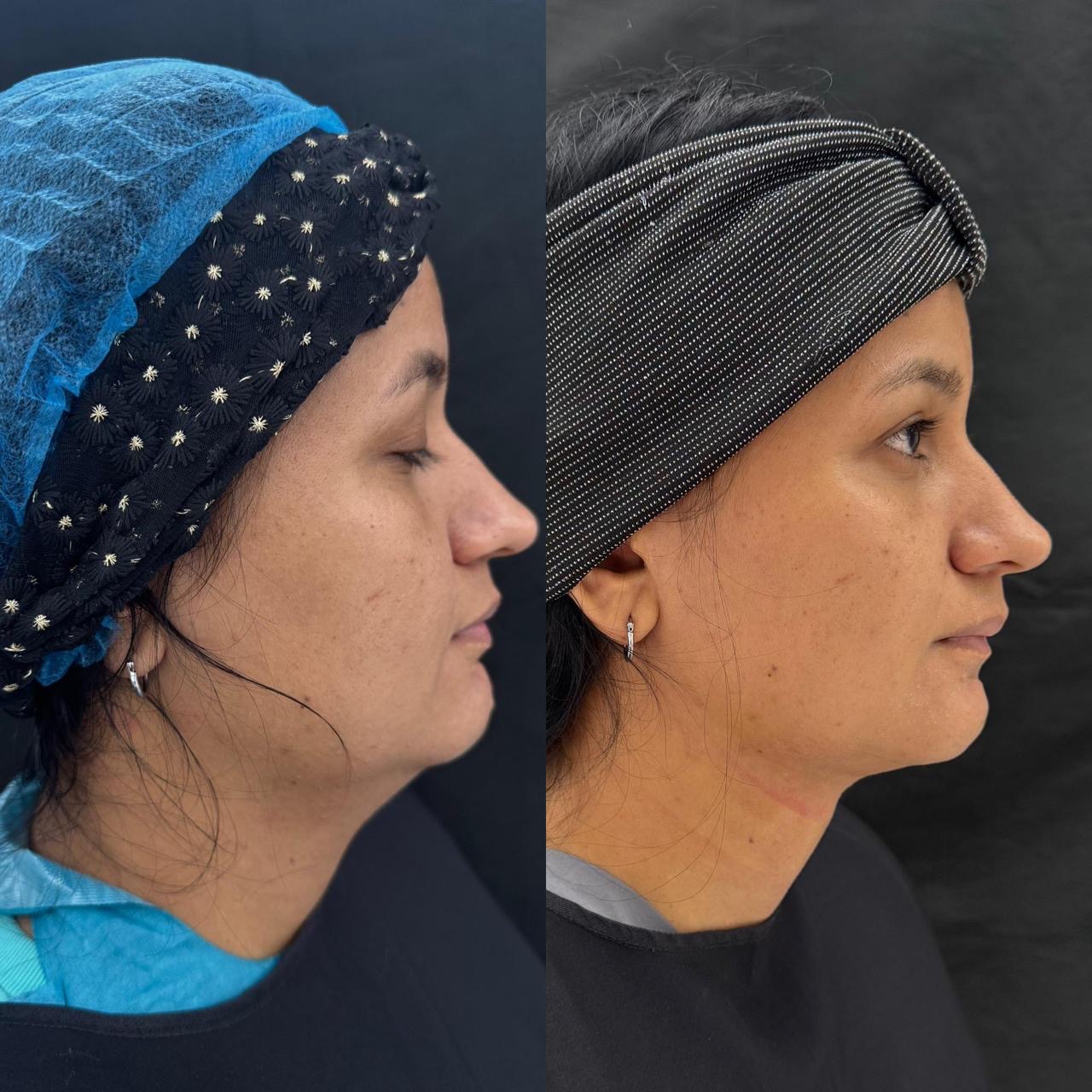Side profile before and after comparison showing face and neck contour refinement