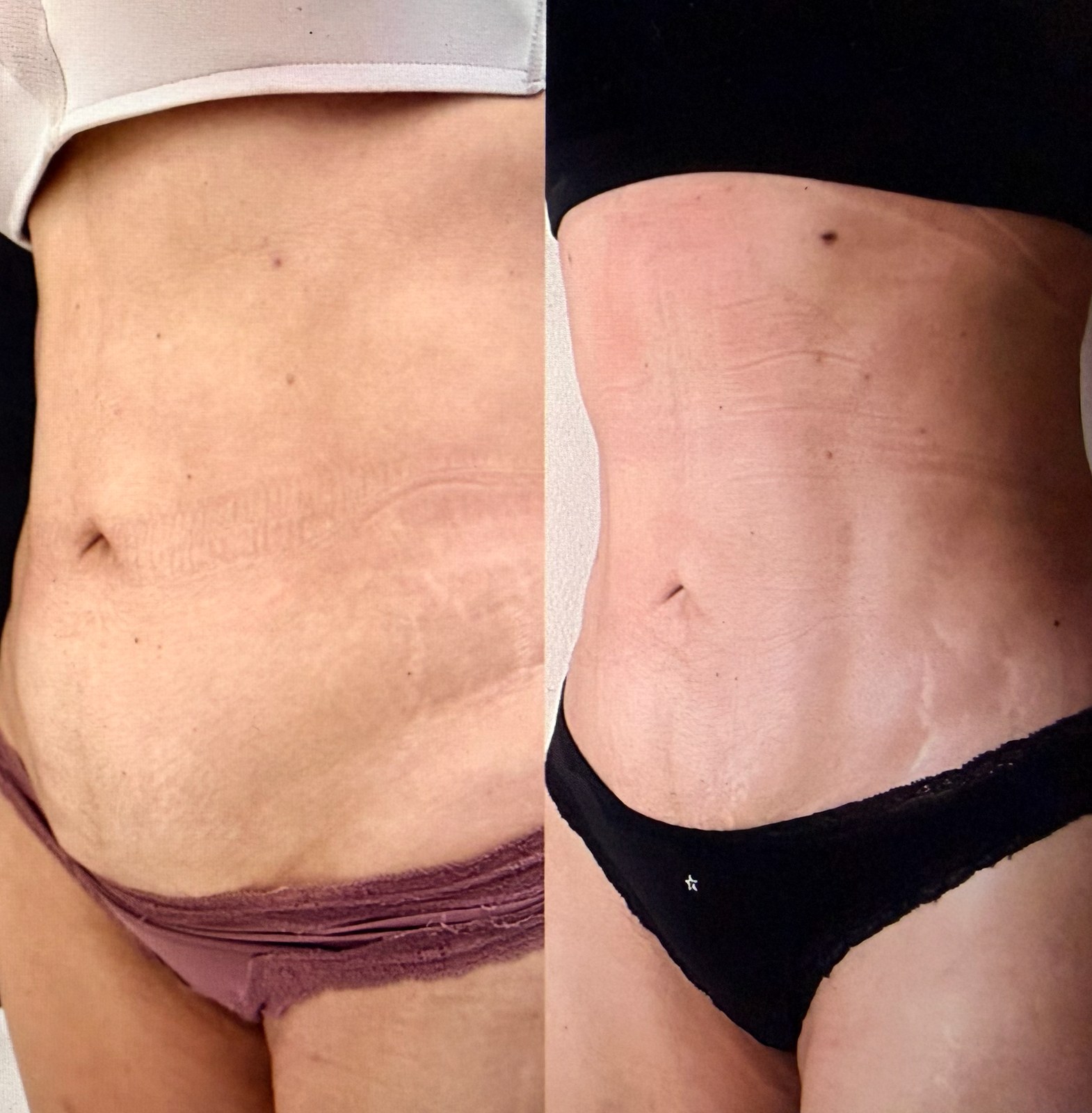 Abdominal before and after comparison showing body contour refinement