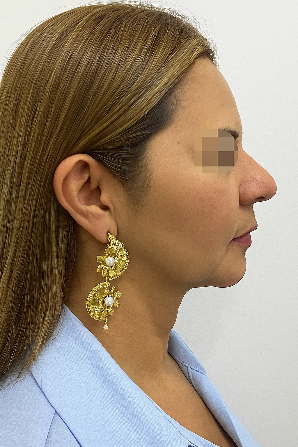 After side profile image showing face and neck contour refinement
