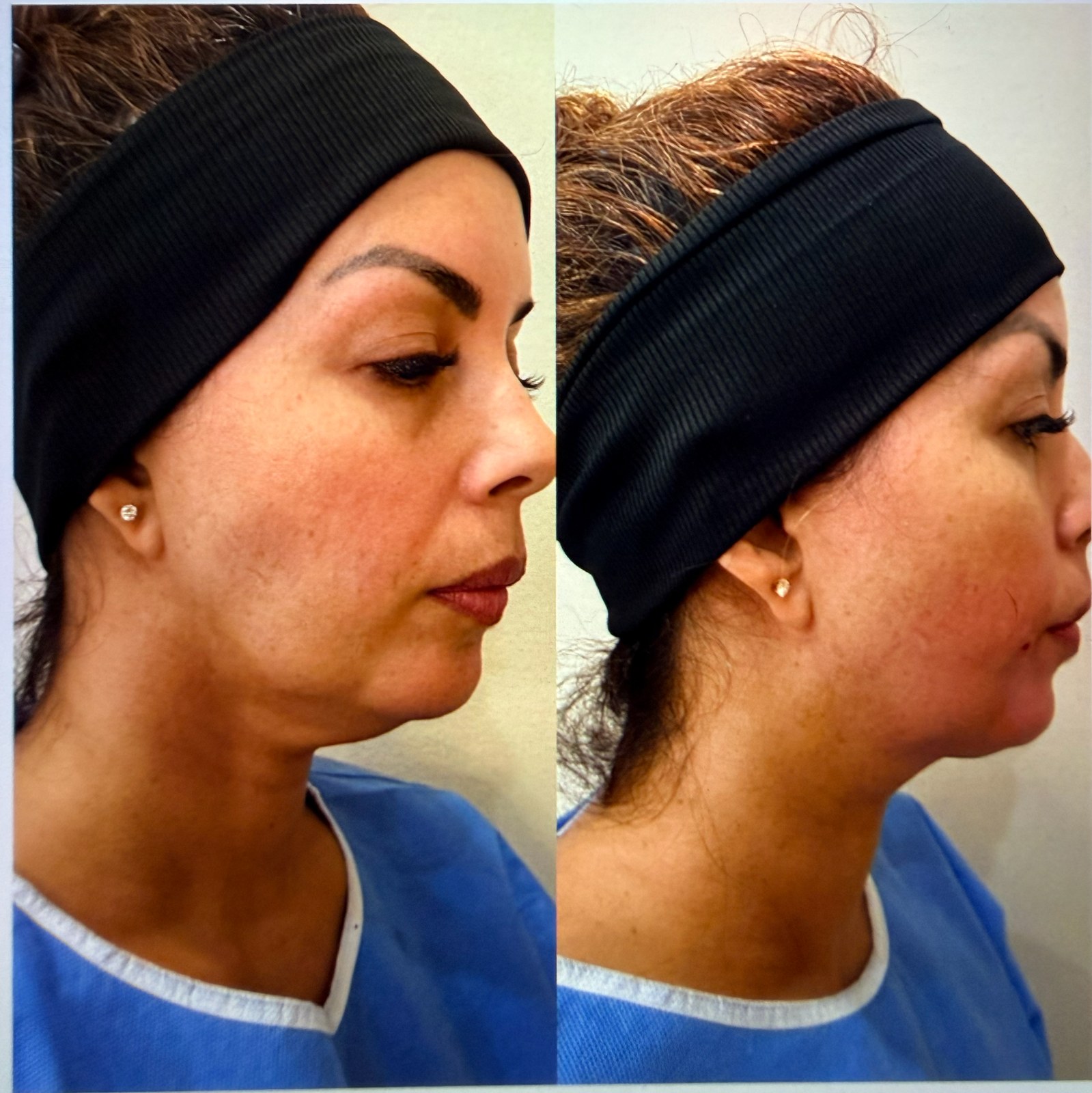 Before and after visual reference for face and neck contour refinement
